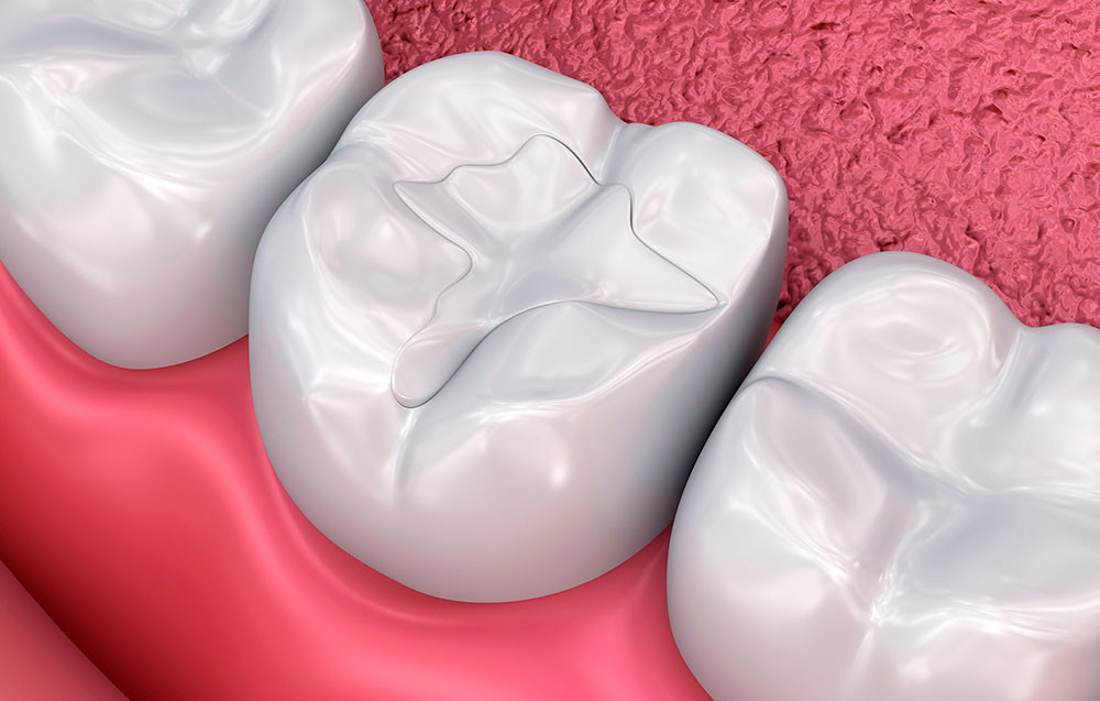 Postopki in materiali ob asistiranju pri izdelavi zalivk