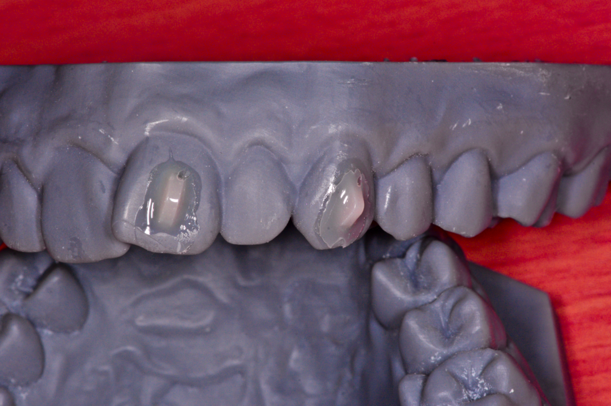 IAS Academy - ClearSmile Aligner Light in Inman Aligner