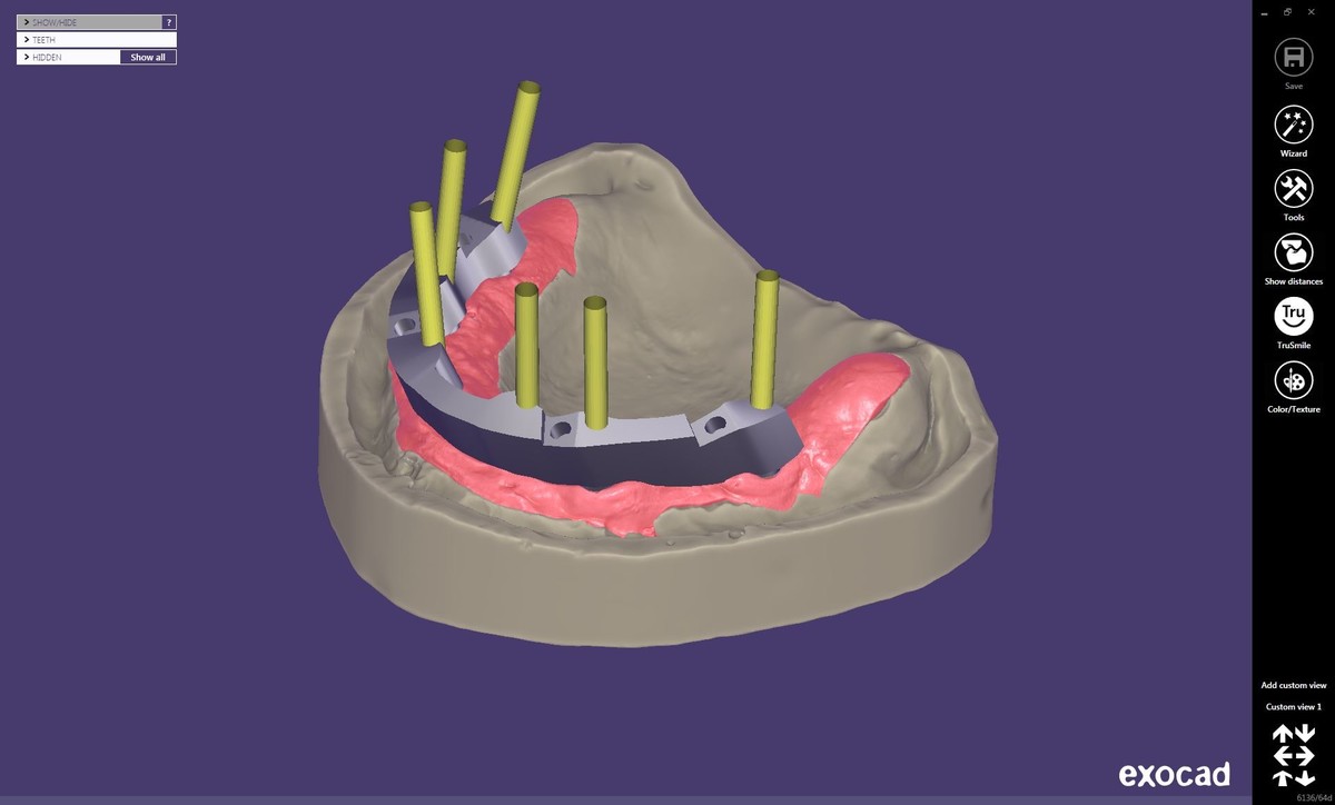 EXOCAD – Gred na implantatih