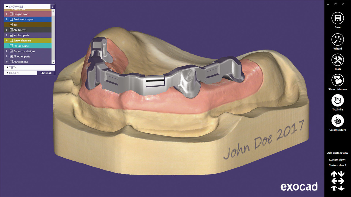 EXOCAD – Gred na implantatih