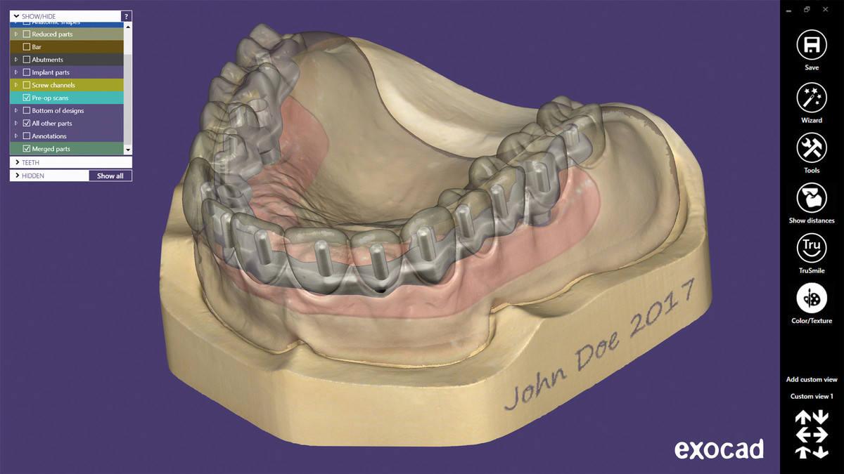 EXOCAD – Gred na implantatih