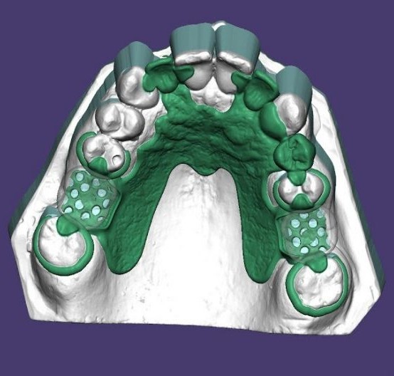 EXOCAD – Partial CAD