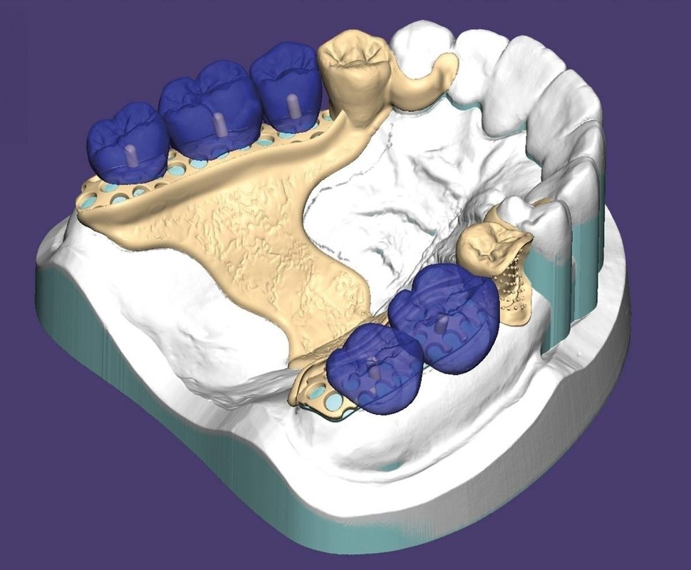 EXOCAD – Partial CAD