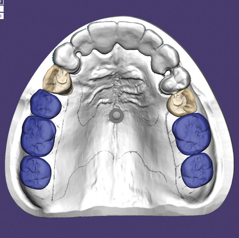 EXOCAD – Partial CAD